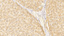 DAB staining on IHC-P; Samples: Human Liver Tissue;  Primary Ab: 20μg/ml Rabbit Anti-Human IL1a Antibody Second Ab: 2µg/mL HRP-Linked Caprine Anti-Rabbit IgG Polyclonal Antibody 