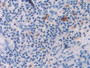 DAB staining on IHC-P; Samples: Human Skin cancer Tissue; Primary Ab: 10µg/ml Rabbit Anti-Human IL18 Antibody Second Ab: 2µg/mL HRP-Linked Caprine Anti-Rabbit IgG Polyclonal Antibody