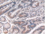 DAB staining on IHC-P; Samples: Human Stomach Cancer Tissue