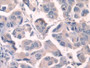 DAB staining on IHC-P; Samples: Human Breast cancer Tissue; Primary Ab: 20µg/ml Rabbit Anti-Human FN Antibody Second Ab: 2µg/mL HRP-Linked Caprine Anti-Rabbit IgG Polyclonal Antibody