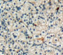 Used in DAB staining on fromalin fixed paraffin-embedded kidney cancer tissue