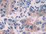 DAB staining on IHC-P; Samples: Human Prostate cancer Tissue; Primary Ab: 30µg/ml Rabbit Anti-Human PTK7 Antibody Second Ab: 2µg/mL HRP-Linked Caprine Anti-Rabbit IgG Polyclonal Antibody