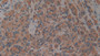 DAB staining on IHC-P; Samples: Human Prostate cancer Tissue; Primary Ab: 10µg/ml Rabbit Anti-Human aZGP1 Antibody Second Ab: 2µg/mL HRP-Linked Caprine Anti-Rabbit IgG Polyclonal Antibody