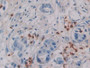 DAB staining on IHC-P; Samples: Human Breast cancer Tissue; Primary Ab: 30µg/ml Mouse Anti-Simian IL6 Antibody Second Ab: 2µg/mL HRP-Linked Caprine Anti-Mouse IgG Polyclonal Antibody