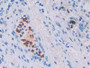 DAB staining on IHC-P; Samples: Human Lung cancer Tissue; Primary Ab: 30µg/ml Mouse Anti-Simian IL6 Antibody Second Ab: 2µg/mL HRP-Linked Caprine Anti-Mouse IgG Polyclonal Antibody