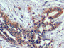 DAB staining on IHC-P; Samples: Human Breast cancer Tissue; Primary Ab: 10µg/ml Mouse Anti-Human TNFa Antibody Second Ab: 2µg/mL HRP-Linked Caprine Anti-Mouse IgG Polyclonal Antibody