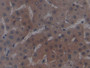 DAB staining on IHC-P; Samples: Human Liver cancer Tissue; Primary Ab: 30µg/ml Mouse Anti-Human ALT Antibody Second Ab: 2µg/mL HRP-Linked Caprine Anti-Mouse IgG Polyclonal Antibody