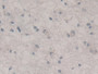 DAB staining on IHC-P; Samples: Human Glioma Tissue)