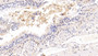 DAB staining on IHC-P; Samples: Human Lung cancer Tissue; Primary Ab: 10ug/ml Mouse Anti-Human ICAM1 Antibody Second Ab: 2µg/mL HRP-Linked Caprine Anti-Mouse IgG Polyclonal Antibody