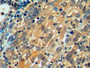DAB staining on IHC-P; Samples: Human Endometrial cancer Tissue)