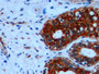 DAB staining on IHC-P; Samples: Human Breast cancer Tissue; Primary Ab: 10µg/ml Mouse Anti-Human KRT18 Antibody Second Ab: 2µg/mL HRP-Linked Caprine Anti-Mouse IgG Polyclonal Antibody
