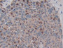DAB staining on IHC-P; Samples: Human Skin cancer Tissue; Primary Ab: 30µg/ml Mouse Anti-Human ADAM17 Antibody Second Ab: 2µg/mL HRP-Linked Caprine Anti-Mouse IgG Polyclonal Antibody