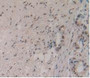 DAB staining on IHC-P; Samples: Human Pancreas Cancer Tissue.