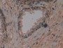 DAB staining on IHC-P; Samples: Human Prostate Tissue; Primary Ab: 30µg/ml Mouse Anti-Human S100A6 Antibody Second Ab: 2µg/mL HRP-Linked Caprine Anti-Mouse IgG Polyclonal Antibody