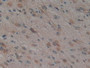 DAB staining on IHC-P;;Samples: Human Glioma Tissue.