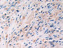 DAB staining on IHC-P; Samples: Human Prostate cancer Tissue; Primary Ab: 30µg/ml Mouse Anti-Human IL33 Antibody Second Ab: 2µg/mL HRP-Linked Caprine Anti-Mouse IgG Polyclonal Antibody