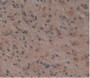 Figure.DAB staining on IHC-P&lt;br/&gt;Samples:Human Glioma Tissue.