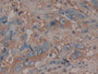 DAB staining on IHC-P; Samples: Human Breast cancer Tissue; Primary Ab: 30µg/ml Mouse Anti-Human AT Antibody Second Ab: 2µg/mL HRP-Linked Caprine Anti-Mouse IgG Polyclonal Antibody