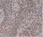 DAB staining on IHC-P;Samples:Human Skin Cancer Tissue