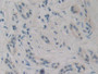 DAB staining on IHC-P; Samples: Human Pancreatic cancer Tissue; Primary Ab: 30µg/ml Mouse Anti-Human EBI3 Antibody Second Ab: 2µg/mL HRP-Linked Caprine Anti-Mouse IgG Polyclonal Antibody