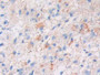 DAB staining on IHC-P; Samples: Human Glioma Tissue; Primary Ab: 30µg/ml Mouse Anti-Human LPCAT3 Antibody Second Ab: 2µg/mL HRP-Linked Caprine Anti-Mouse IgG Polyclonal Antibody