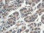 DAB staining on IHC-P; Samples: Human Pancreatic cancer Tissue; Primary Ab: 30µg/ml Mouse Anti-Human C5a Antibody Second Ab: 2µg/mL HRP-Linked Caprine Anti-Mouse IgG Polyclonal Antibody