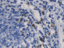 DAB staining on IHC-P; Samples: Human Stomach cancer Tissue;  Primary Ab: 20µg/ml Mouse Anti-Human C