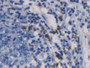 DAB staining on IHC-P; Samples: Human Stomach cancer Tissue)