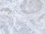 Figure. DAB staining on IHC-P; Samples: Human Prostate Gland Cancer Tissue.