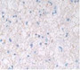 DAB staining on IHC-P; Samples: Human Glioma Tissue.