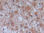 DAB staining on IHC-P; Samples: Human Glioma Tissue; Primary Ab: 30µg/ml Mouse Anti-Human cPLA2 Antibody Second Ab: 2µg/mL HRP-Linked Caprine Anti-Mouse IgG Polyclonal Antibody