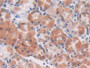 DAB staining on IHC-P; Samples: Human Stomach cancer Tissue; Primary Ab: 30µg/ml Mouse Anti-Human S100A5 Antibody Second Ab: 2µg/mL HRP-Linked Caprine Anti-Mouse IgG Polyclonal Antibody