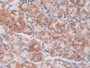 DAB staining on IHC-P;;Samples: Human Stomach Cancer Tissue