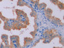 DAB staining on IHC-P; Samples: Human Prostate Tissue;  Primary Ab: 10µg/ml Mouse Anti-Human TIMP1 Antibody Second Ab: 2µg/mL HRP-Linked Caprine Anti-Mouse IgG Polyclonal Antibody 