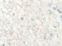 DAB staining on IHC-P; Samples: Human Glioma Tissue