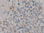 DAB staining on IHC-P; Samples: Human Stomach cancer Tissue; Primary Ab: 30µg/ml Mouse Anti-Human IL12A Antibody Second Ab: 2µg/mL HRP-Linked Caprine Anti-Mouse IgG Polyclonal Antibody