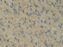 DAB staining on IHC-P; Samples: Human Glioma Tissue; Primary Ab: 30µg/ml Mouse Anti-Human IL12A Antibody Second Ab: 2µg/mL HRP-Linked Caprine Anti-Mouse IgG Polyclonal Antibody