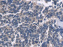 DAB staining on IHC-P; Samples: Human Lung cancer Tissue;  Primary Ab: 20µg/ml Mouse Anti-Human EDN1