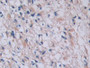 DAB staining on IHC-P; Samples: Human Glioma Tissue;  Primary Ab: 40µg/ml Mouse Anti-Human TPS Antib