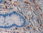 DAB staining on IHC-P; Samples: Human Colorectal cancer Tissue; Primary Ab: 40µg/ml Mouse Anti-Human TPS Antibody Second Ab: 2µg/mL HRP-Linked Caprine Anti-Mouse IgG Polyclonal Antibody