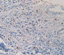 DAB staining on IHC-P; Samples: Human Prostate Gland Cancer Tissue.