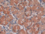 DAB staining on IHC-P; Samples: Human Stomach cancer Tissue; Primary Ab: 20µg/ml Mouse Anti-Human IL28A Antibody Second Ab: 2µg/mL HRP-Linked Caprine Anti-Mouse IgG Polyclonal Antibody