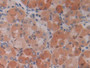 DAB staining on IHC-P; Samples: Human Stomach cancer Tissue; Primary Ab: 20µg/ml Mouse Anti-Human IL28A Antibody Second Ab: 2µg/mL HRP-Linked Caprine Anti-Mouse IgG Polyclonal Antibody