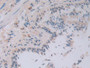 DAB staining on IHC-P; Samples: Human Stomach cancer Tissue)