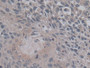 DAB staining on IHC-P; Samples: Human Lung cancer Tissue)