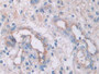 DAB staining on IHC-P; Samples: Human Glioma Tissue; Primary Ab: 20µg/ml Mouse Anti-Human IL33 Antibody Second Ab: 2µg/mL HRP-Linked Caprine Anti-Mouse IgG Polyclonal Antibody