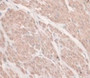 DAB staining on IHC-P; Samples: Human Prostate Gland Cancer Tissue.