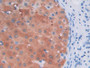 DAB staining on IHC-P; Samples: Human Liver cancer Tissue;  Primary Ab: 30µg/ml Mouse Anti-Human IDH