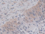 DAB staining on IHC-P; Samples: Human Lung cancer Tissue;  Primary Ab: 20µg/ml Mouse Anti-Human CYPA