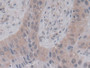 DAB staining on IHC-P; Samples: Human Lung cancer Tissue)